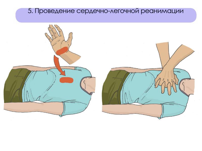 Сердечно легочная реанимация рисунок