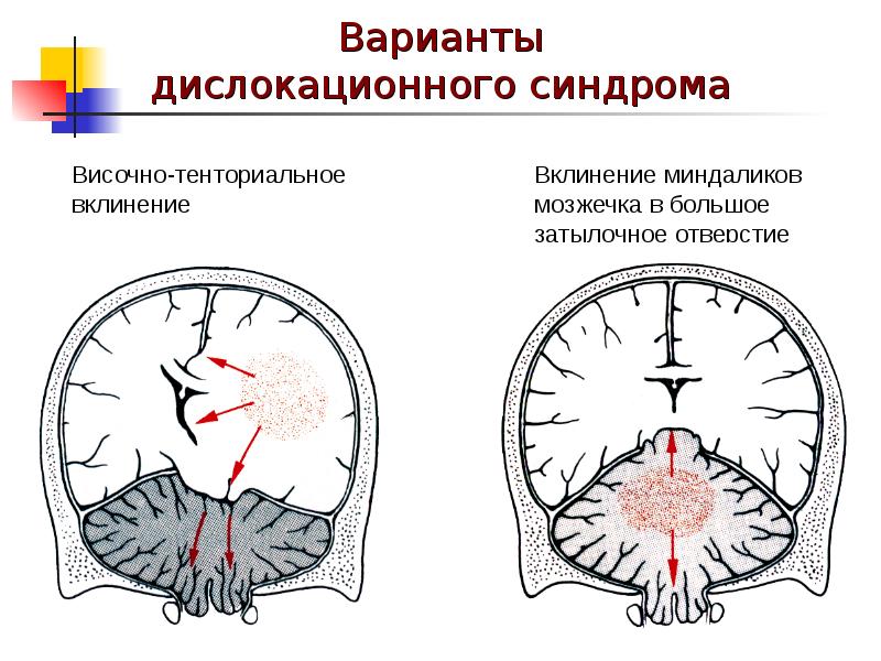 Мр картина косвенных признаков внутричерепной гипертензии