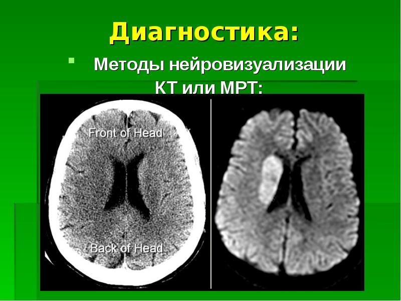 Ишемический инсульт головного мозга презентация