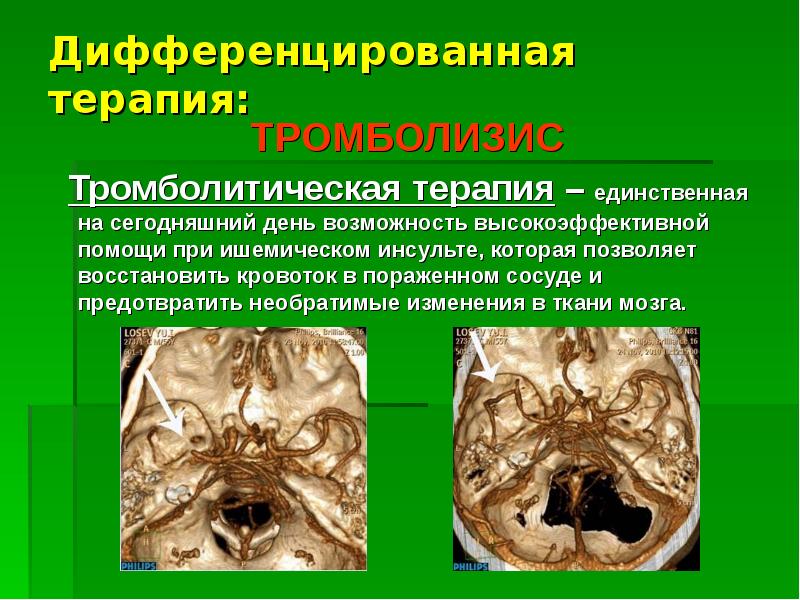 Ишемический инсульт головного мозга презентация