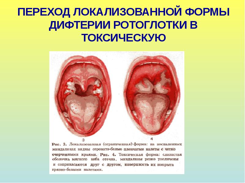 Детские инфекции презентация