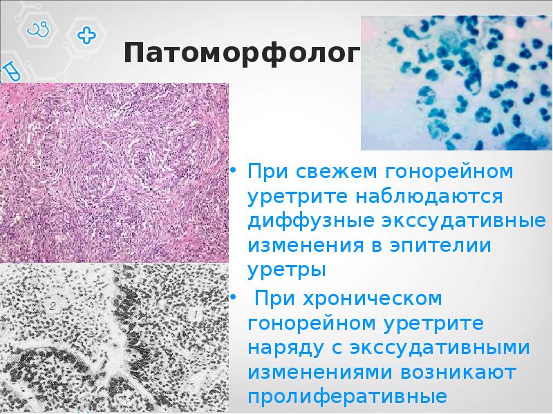 Презентация на тему гонорея