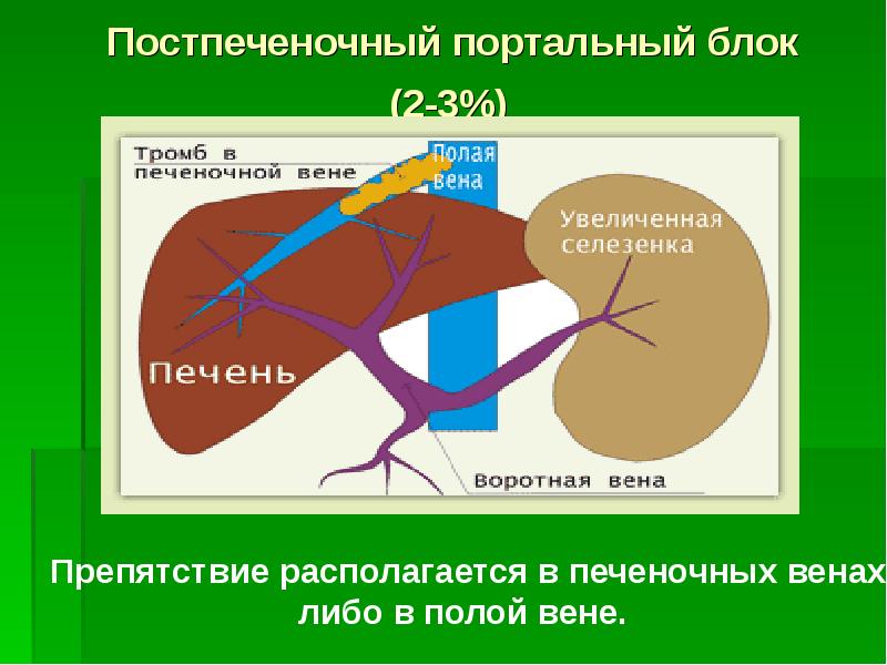 Портальная гипертензия картинки