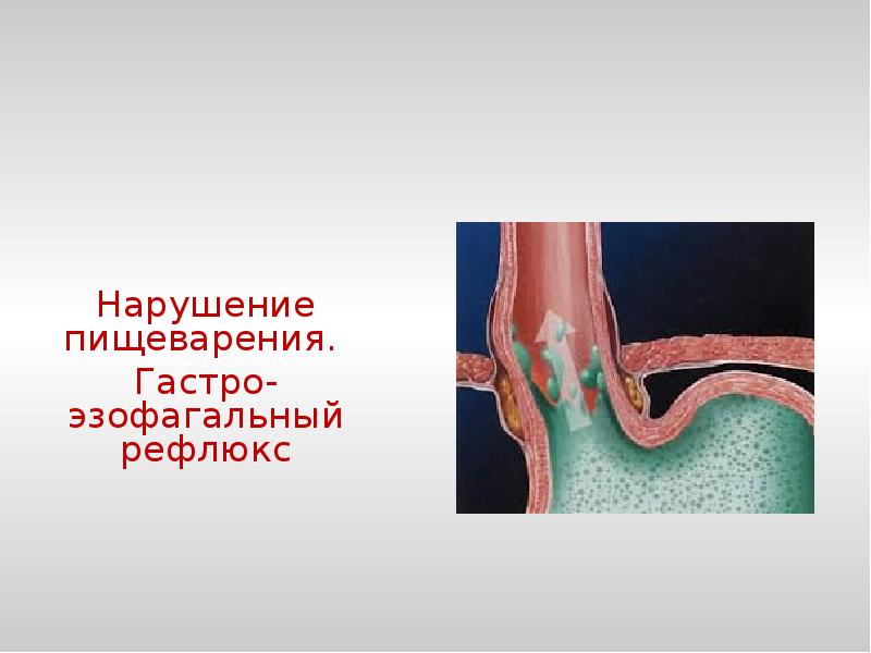 Препарат нарушение пищеварения. Гастро-эзофагальный рефлюкс. Нарушение пищеварения.