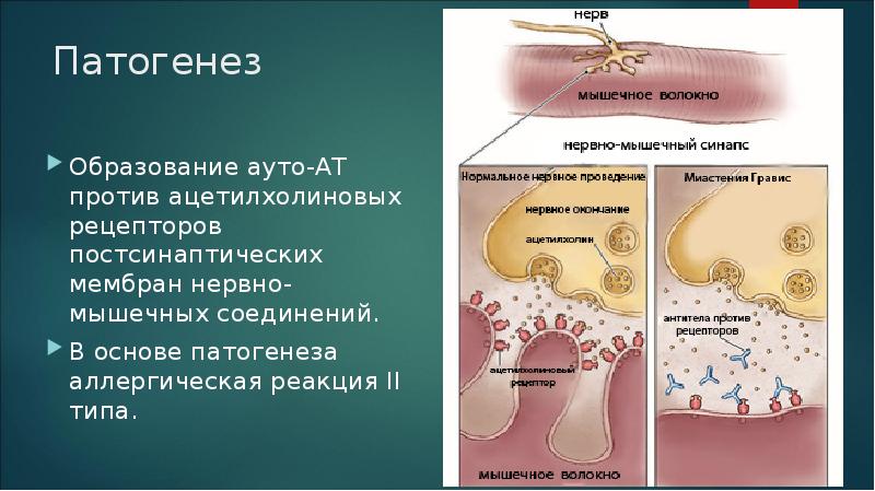 Доклад: Миастения Доклад: Миастения