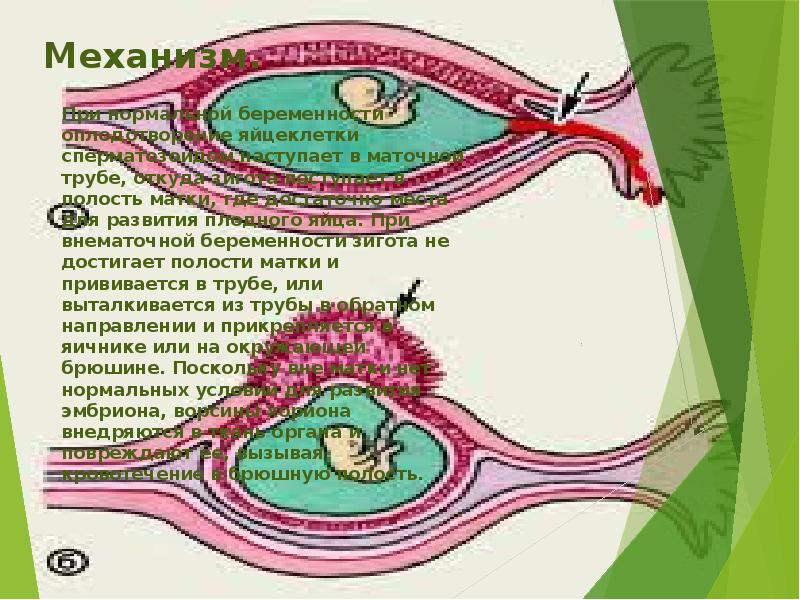 Может ли яйцеклетка попасть в противоположную трубу