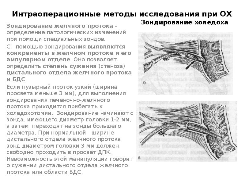 Холецистит презентация по хирургии