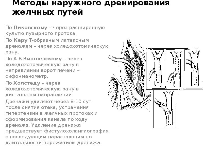 Наружный способ. Дренирование холедоха через культю пузырного протока. Дренирование желчных протоков по авторам. Способы наружного дренирования общего желчного протока. Дренаж холедоха через культю пузырного протока.