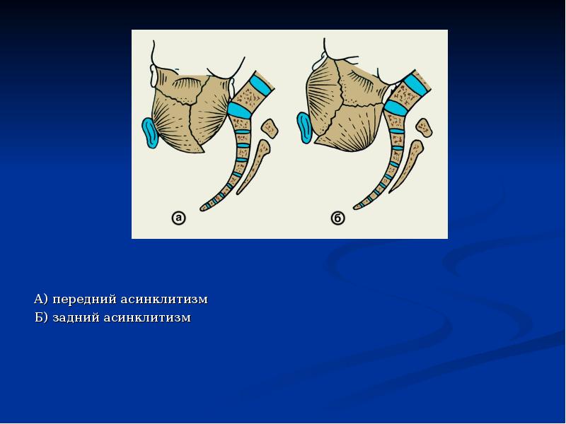 А) передний асинклитизм А) передний асинклитизм Б) задний асинклитизм