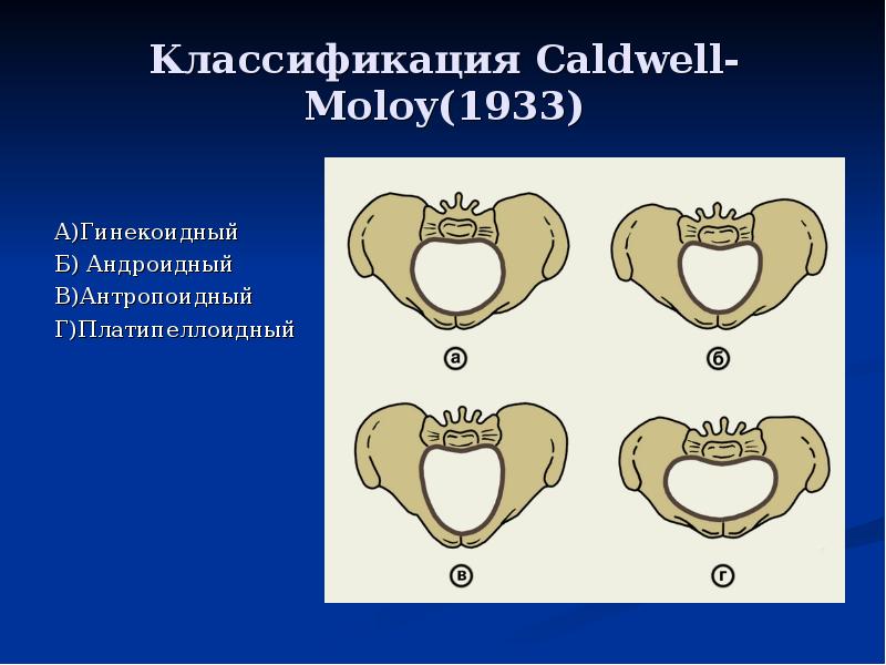Классификация Caldwell-Moloy(1933) А)Гинекоидный Б) Андроидный В)Антропоидный Г)Платипеллоидный