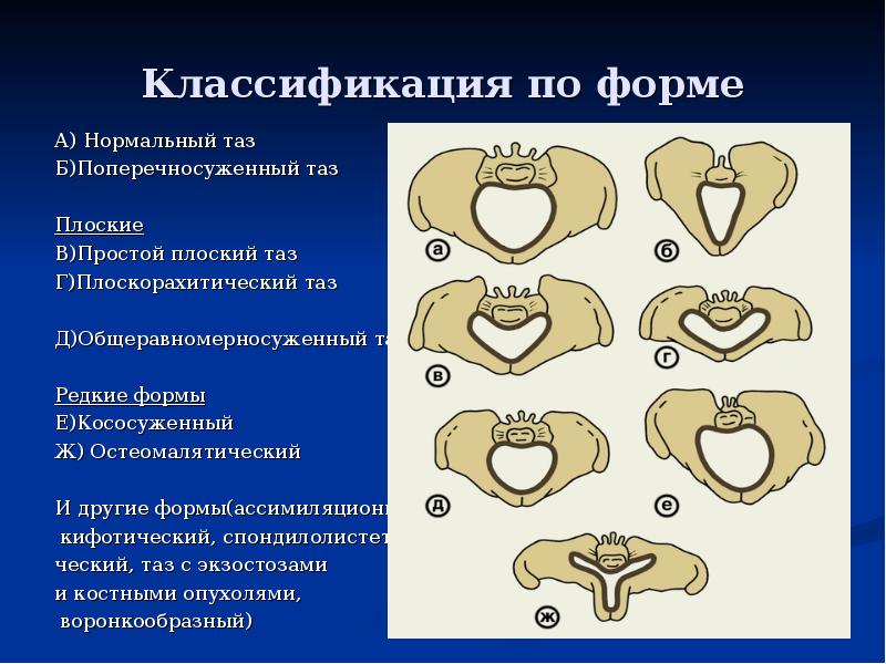 Классификация по форме А) Нормальный таз Б)Поперечносуженный таз  Плоские В)Простой