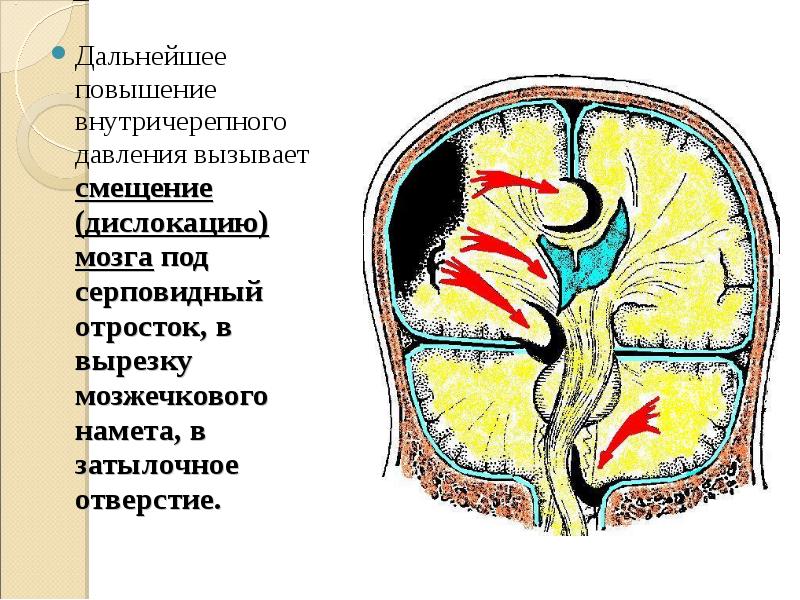 Серп мозжечка анатомия. Намет мозжечка анатомия мрт. Вырезка намета мозжечка анатомия. Дислокация головного мозга.