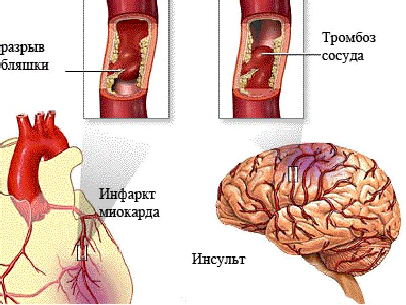 Инсульт сердца презентация