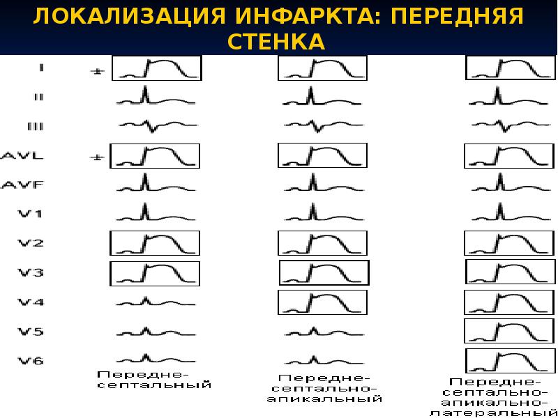 Ишемия нижней стенки на экг