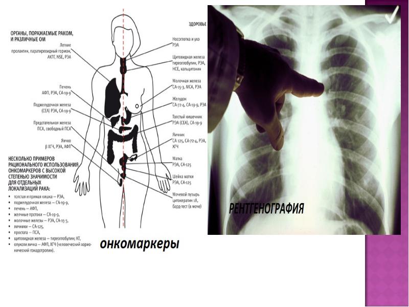 Рак внутренних органов