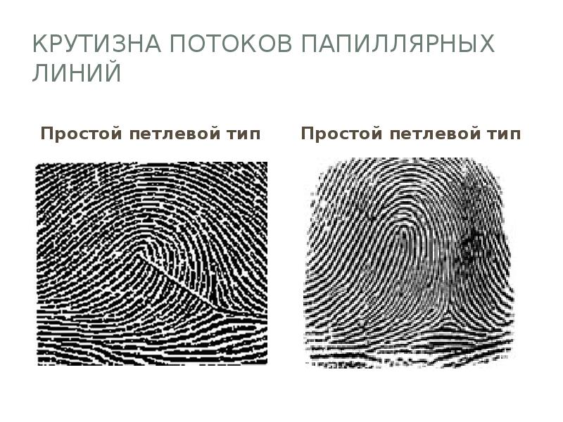 Крутизна потоков папиллярных линий Простой петлевой тип