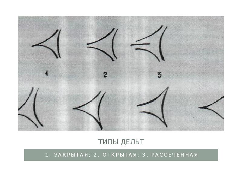 Типы дельт 1. закрытая; 2. открытая; 3. рассеченная
