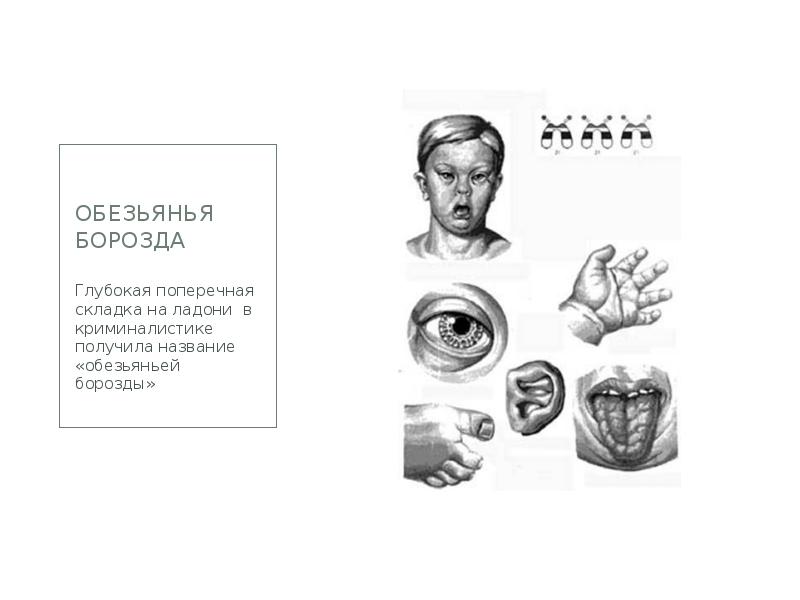 Обезьянья борозда  Глубокая поперечная складка на ладони в криминалистике получила