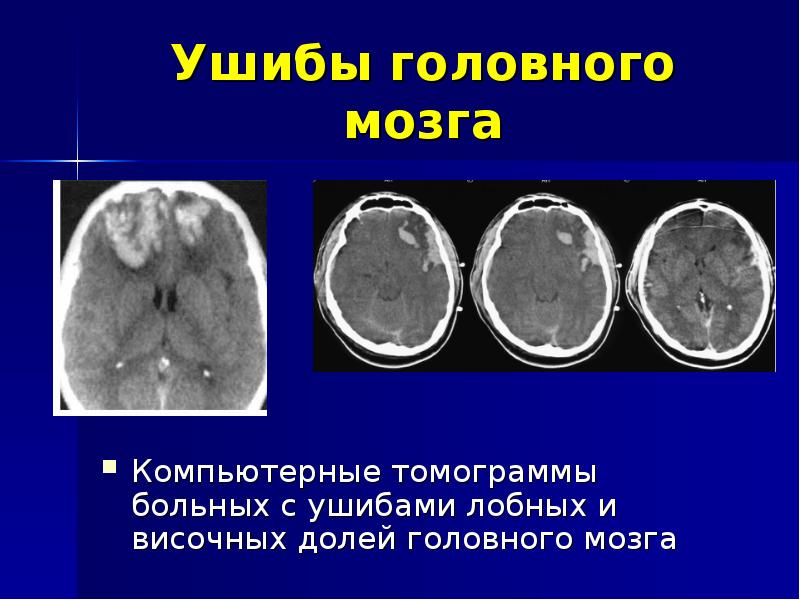 Презентация ушиб головного мозга