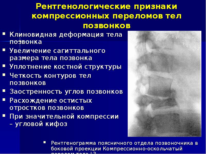 Компрессионный перелом позвоночника что это такое у детей фото и последствия