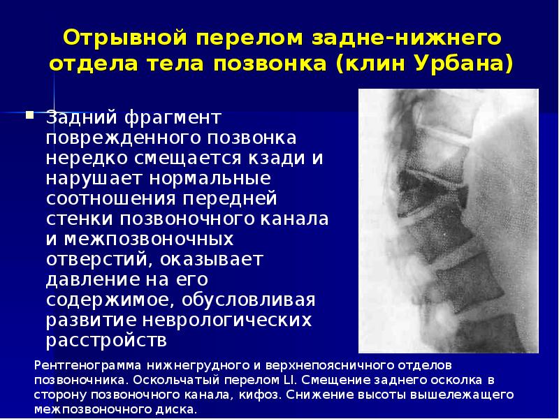 Симптомы трещины заднего. Клиновидный компрессионный перелом позвоночника. Перелом тела позвоночника. Отрывной перелом позвонка.
