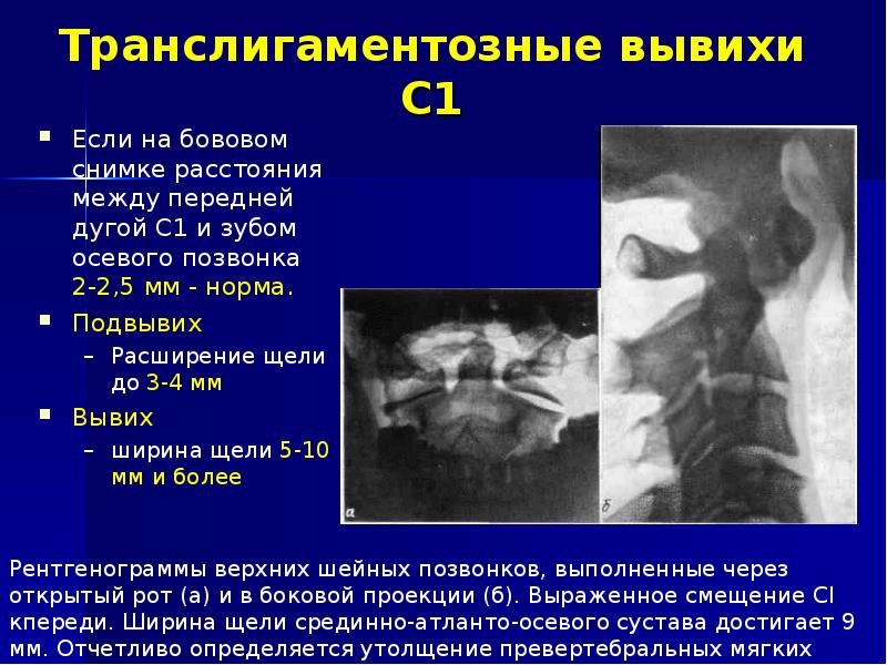 Ротационный подвывих. Подвывих первого шейного позвонка рентген. Подвывих позвонка рентген. Подвывих с1 с2. Асимметрия срединного атланто-аксиального сочленения.