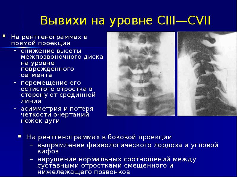 Вывих шейного позвонка карта вызова