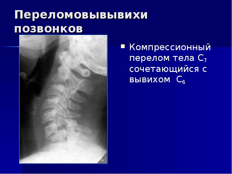 Перелом позвоночника презентация