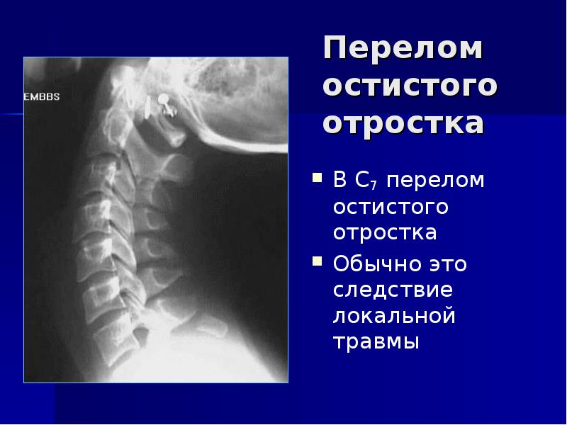 Презентация на тему расщепление позвоночника