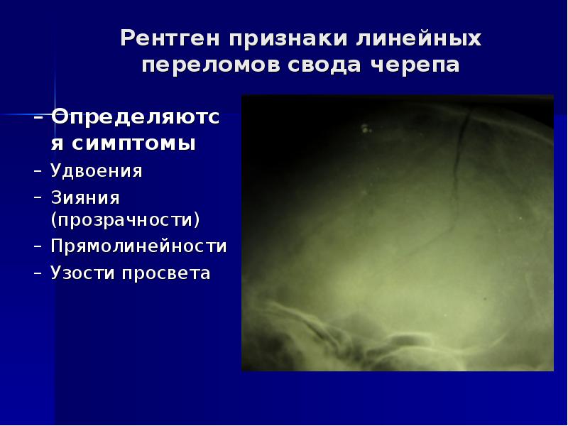 Линейная осу преимущества. Линейные программы примеры. Линейные и ветвящиеся алгоритмы. Рентген признаки линейных переломов свода черепа. Линейный перелом свода черепа.