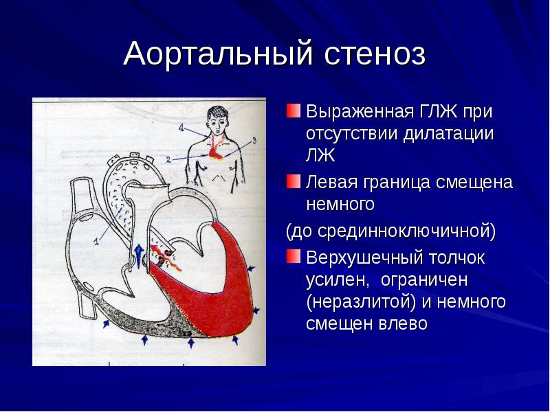 Приобретенные пороки сердца у детей презентация