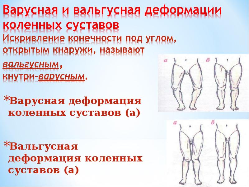 Деформация коленного сустава у детей
