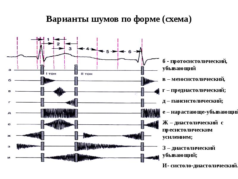 Шум фактор. Соотношение тонов и шумов сердца. Тоны и шумы сердца. Тоны и шумы сердца графически. Характеристика тонов и шумов сердца.