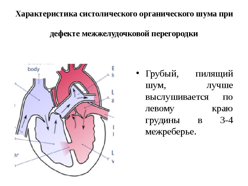 Межжелудочковая перегородка. Мембранозная часть межжелудочковой перегородки. Шум при дефекте межжелудочковой перегородки. Аускультация сердца - дефект межжелудочковой перегородки. Мембранная часть межжелудочковой перегородки.