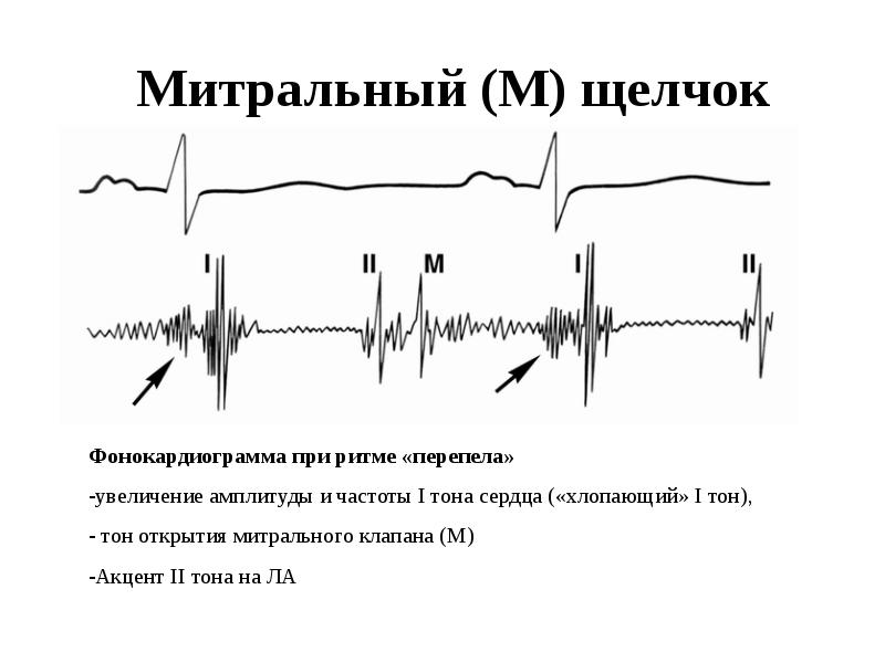 Ритм галопа