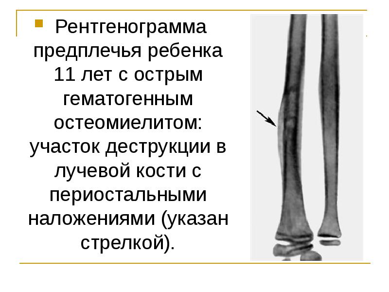 Остеомиелит у детей презентация