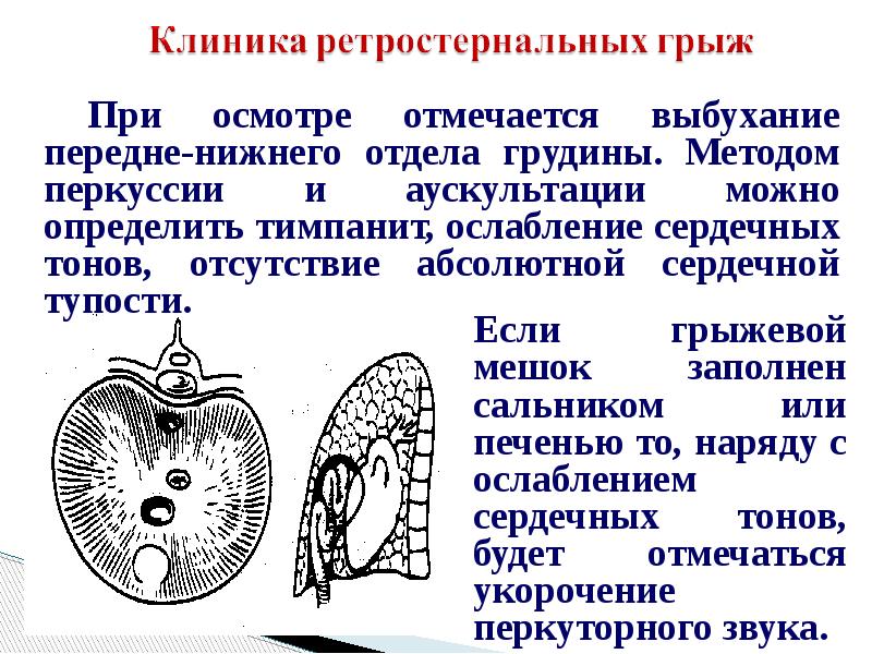 Презентация на тему диафрагмальные грыжи