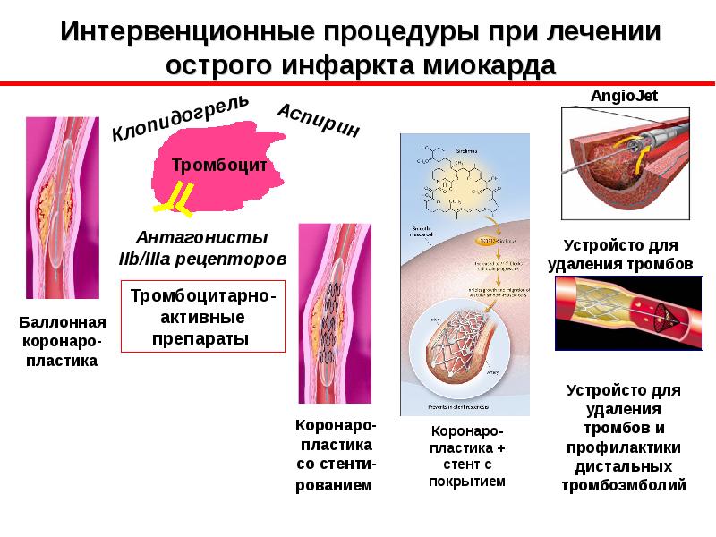 Острый коронарный синдром презентация 2016