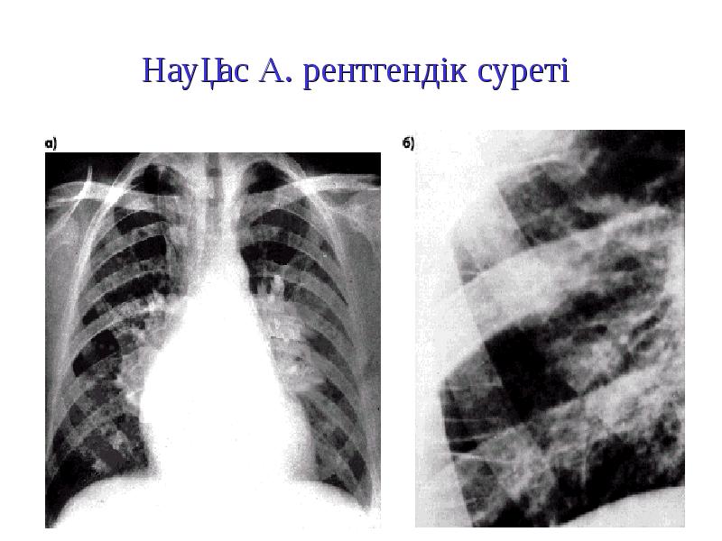 Пневмония ауруы презентация