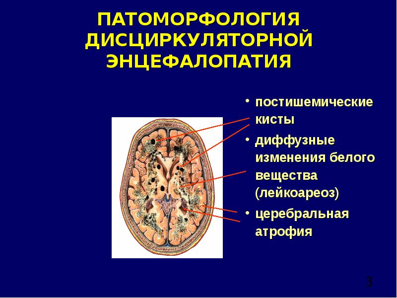 Картина очаговых изменений вещества мозга дисциркуляторного характера