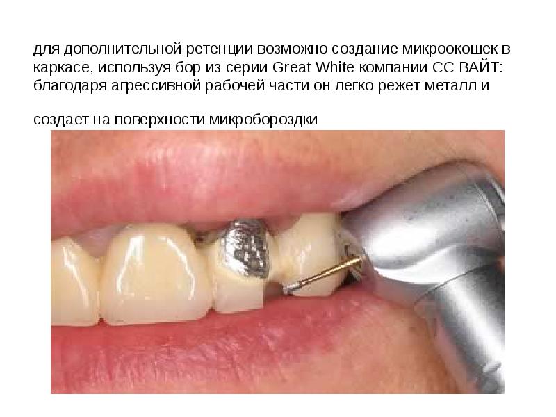 для дополнительной ретенции возможно создание микроокошек в каркасе, используя бор из