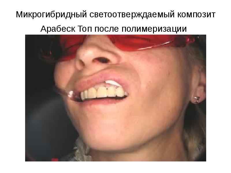 Микрогибридный светоотверждаемый композит Арабеск Топ после полимеризации