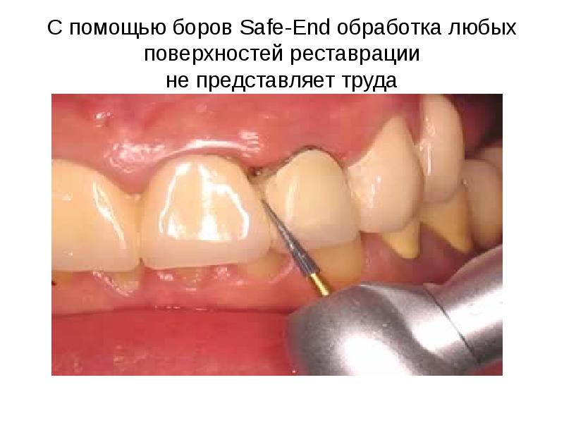 С помощью боров Safe-End обработка любых поверхностей реставрации не представляет труда