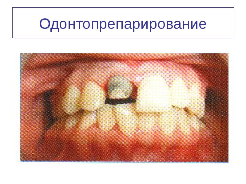 Одонтопрепарирование
