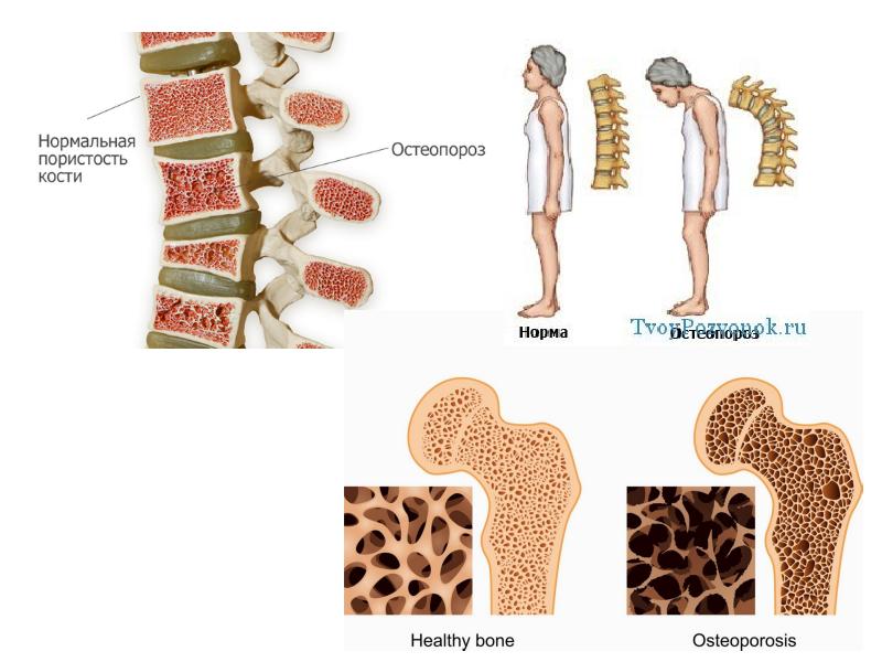 Остеопороз костей. Остеопороз кости. Структура кости при остеопорозе. Нормальная кость и остеопороз. Здоровая кость и кость при остеопорозе.