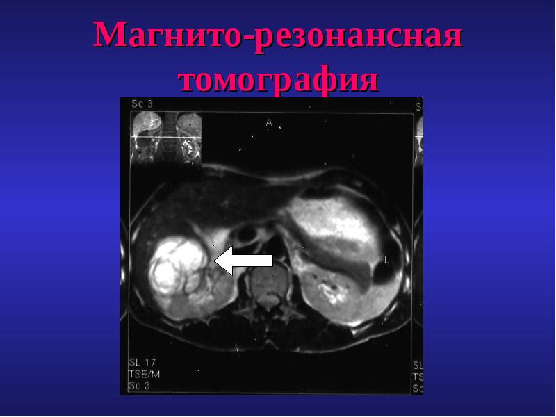 Презентация на тему эхинококкоз