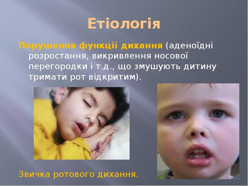 Етіологія Порушення функції дихання (аденоїдні розростання, викривлення носової перегородки і т.д.,