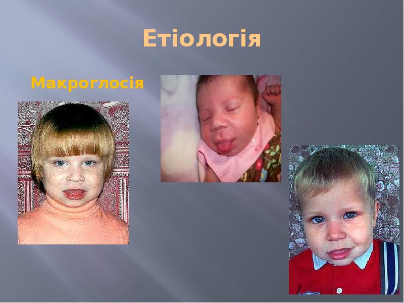 Етіологія Макроглосія