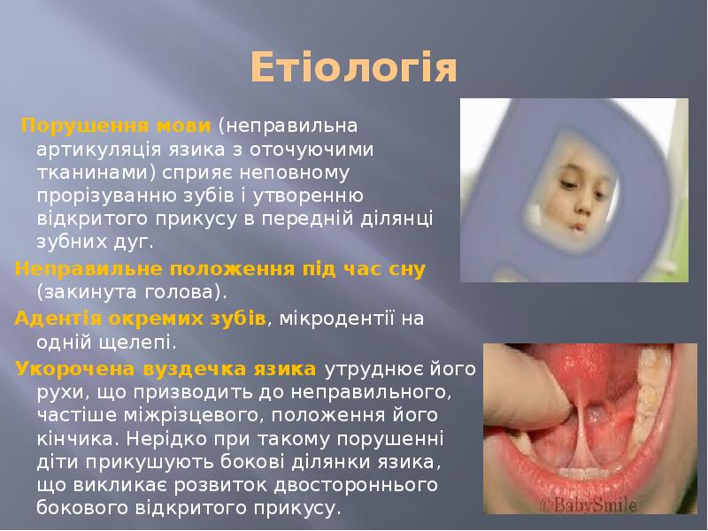 Етіологія  Порушення мови (неправильна артикуляція язика з оточуючими тканинами) сприяє
