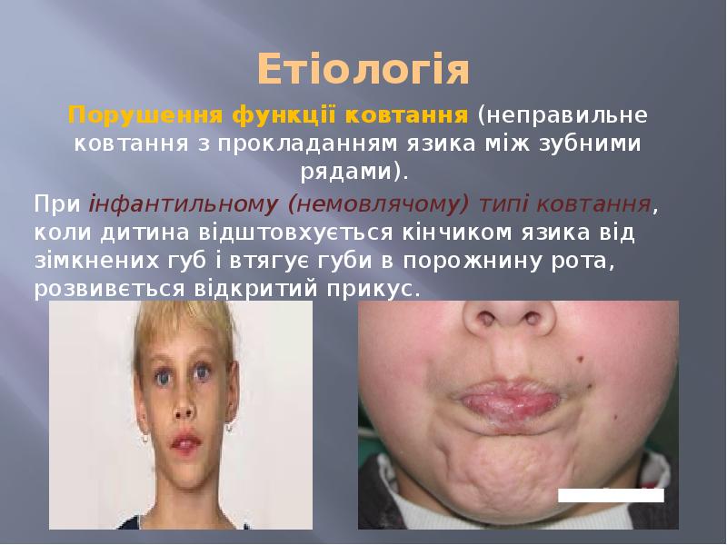 Етіологія Порушення функції ковтання (неправильне ковтання з прокладанням язика між зубними